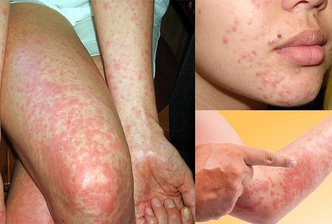 Dị ứng thời tiết có tự khỏi được không? Trường hợp nào cần đi khám bác sĩ?