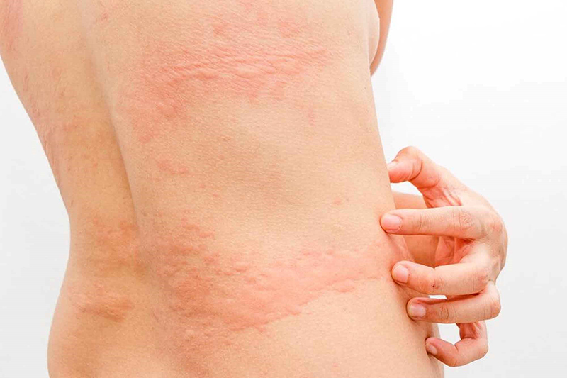 Dị Ứng Thời Tiết Uống Thuốc Gì? TOP Thuốc Điều Trị Triệu Chứng Hiệu Quả 3 Uống thuốc dị ứng thời tiết bao lâu thì khỏi? Yếu tố ảnh hưởng và lời khuyên từ chuyên gia.