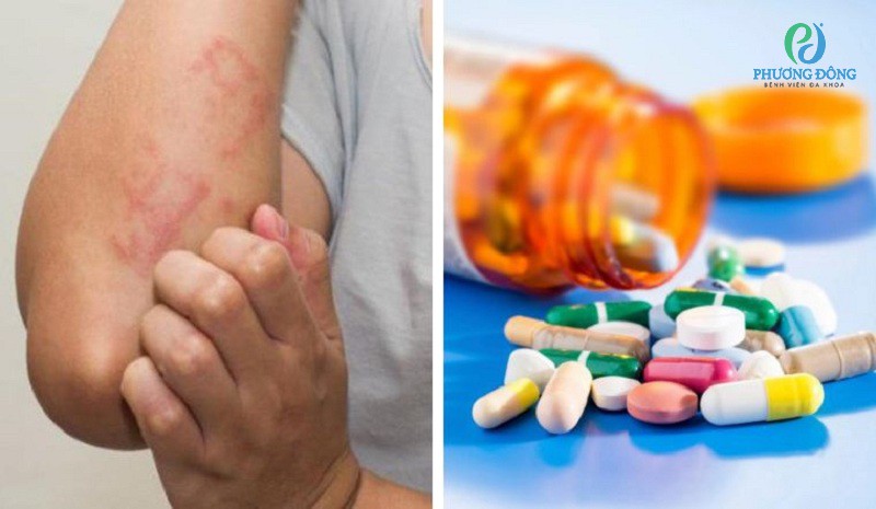 Dị Ứng Thời Tiết Uống Thuốc Gì? TOP Thuốc Điều Trị Triệu Chứng Hiệu Quả 6 Bên cạnh thuốc, đâu là các biện pháp hỗ trợ điều trị và phòng ngừa dị ứng thời tiết hiệu quả?