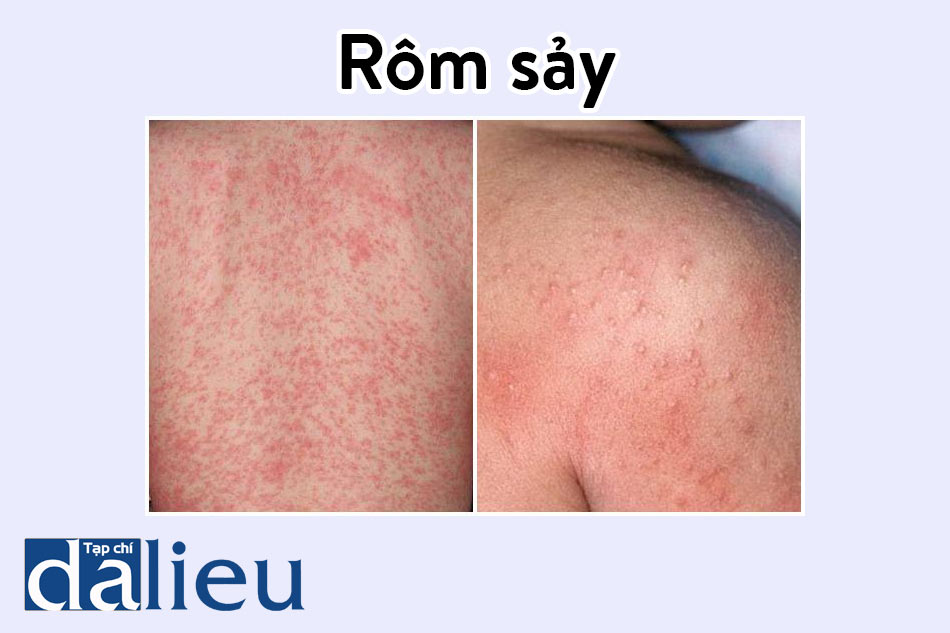 Các bệnh về da do nhiệt: Cháy nắng, rôm sảy và cách phòng ngừa hiệu quả
