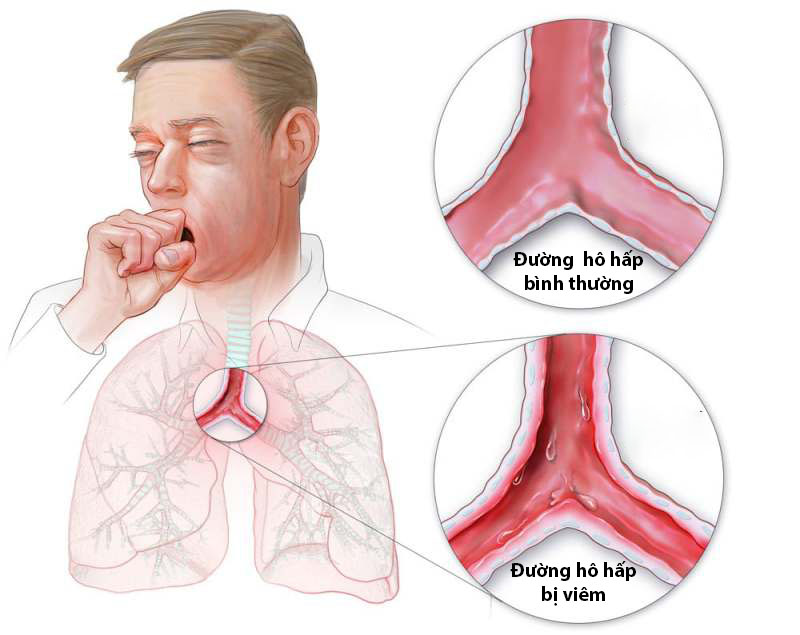 Tác Hại Khi Xông Hơi Quá Nóng: Nguy Cơ, Biện Pháp Phòng Tránh Sốc Nhiệt 4 Tổn Thương Da và Mắt: Nóng Rát Không Nên Xem Nhẹ